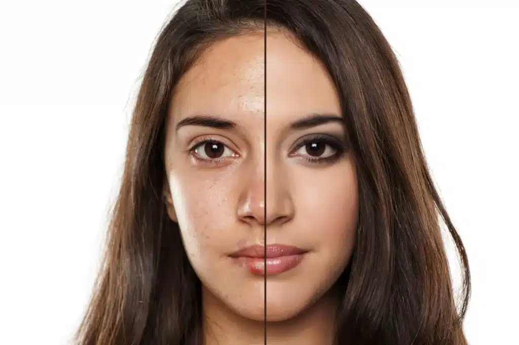 טיפול באקנה בשיטת קרנית מלמד